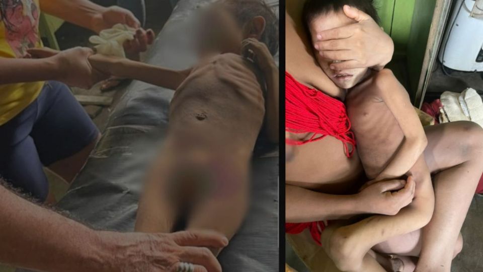 Crianças yanomamis em situação de desnutrição (Divulgação/Condisi-YY)