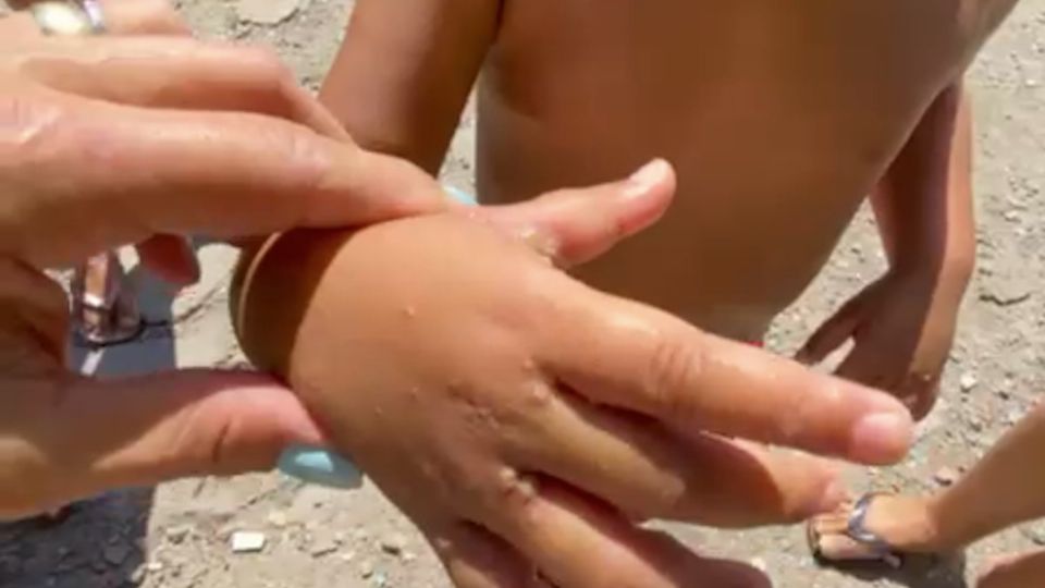 Criança de 4 anos diagnosticada com sarna humana (Arquivo Pessoal)