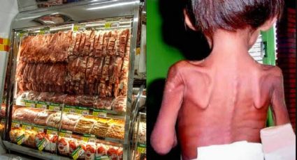 Preço da carne pode levar a explosão de casos de anemia em crianças