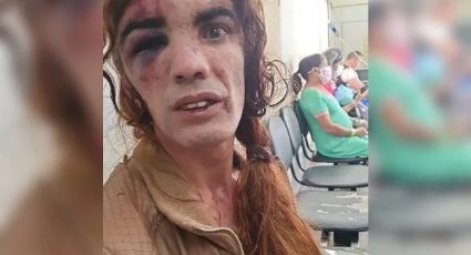 Mulher trans é vítima de trauma no rosto após ser agredida por homem no DF