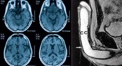 Covid afeta pênis, testículos e reduz tamanho do cérebro, dizem estudos