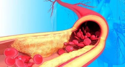 Aterosclerose: Cientistas europeus supõem que haverá tratamentos sem uso de drogas