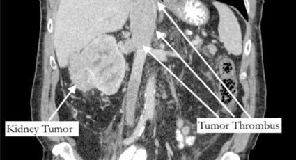 Dor no dedão por 5 anos era um tumor terminal, mas paciente sobrevive