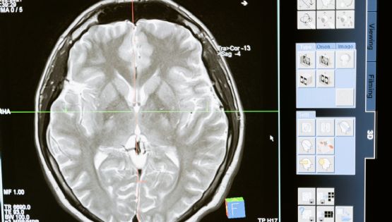 Pessoas que trabalham nestas duas profissões têm menos risco de desenvolver Alzheimer, diz estudo