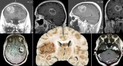 Estudo da USP descobre mecanismo contra resistência de tumor à radioterapia