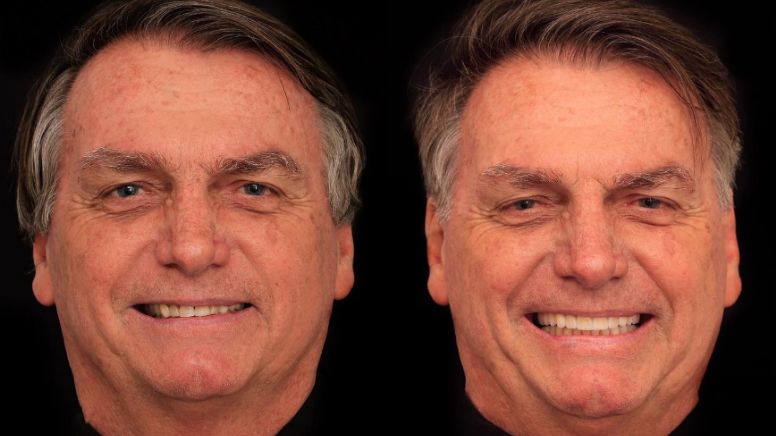 Harmonização facial: funciona ou não? Veja famosos que fizeram e o resultado