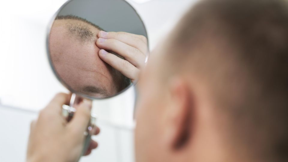 A calvície é um problema comum entre os homens.
