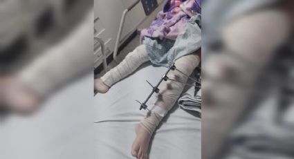 Erro médico grosseiro: Menina de 6 anos tem perna errada operada na PB