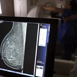 Tomografias podem causar até 5% dos casos de câncer anuais nos EUA, aponta estudo
